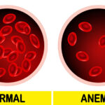 signs of iron deficiency