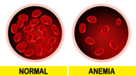 signs of iron deficiency