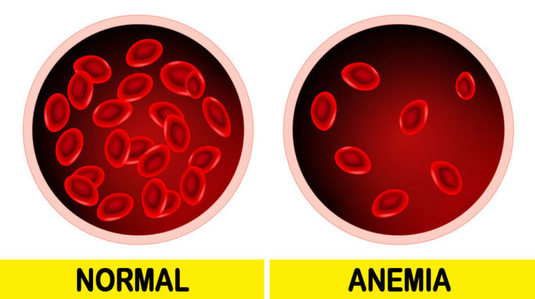 signs of iron deficiency