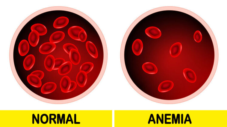 signs of iron deficiency