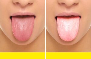 swelling soreness of the mouth and tongue