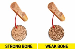 weak bones